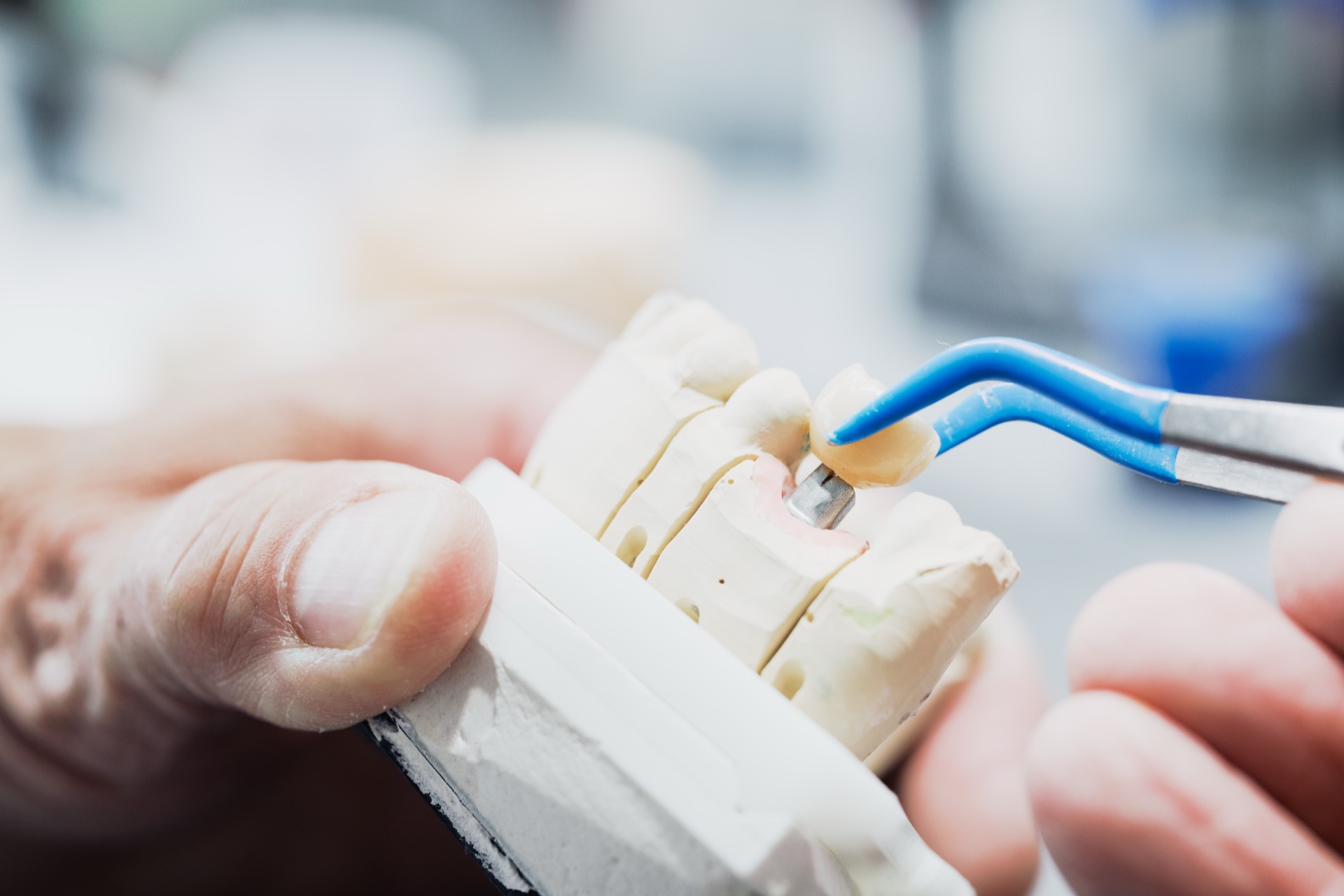 Zahntechniker setzt Zahnkrone präzise auf das Modell im Dentallabor der Stadtwald Klinik